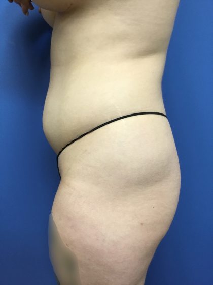 Liposuction Before & After Patient #2191