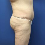 Liposuction Before & After Patient #2196