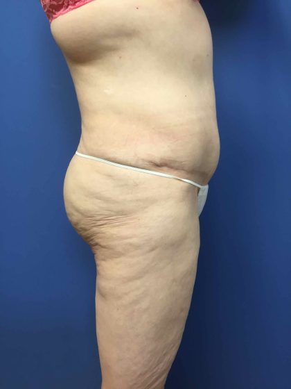 Liposuction Before & After Patient #2196