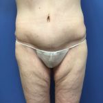 Liposuction Before & After Patient #2196