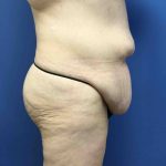 Liposuction Before & After Patient #2196