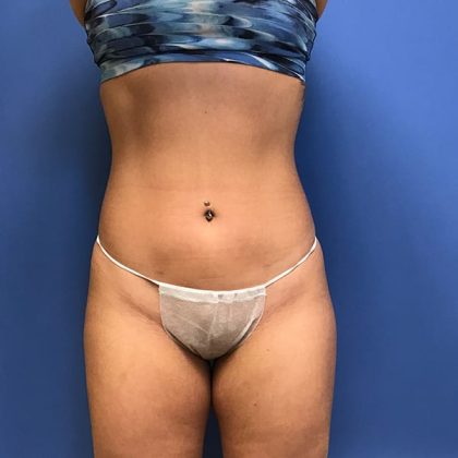 Liposuction Before & After Patient #2201