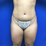 Liposuction Before & After Patient #2201