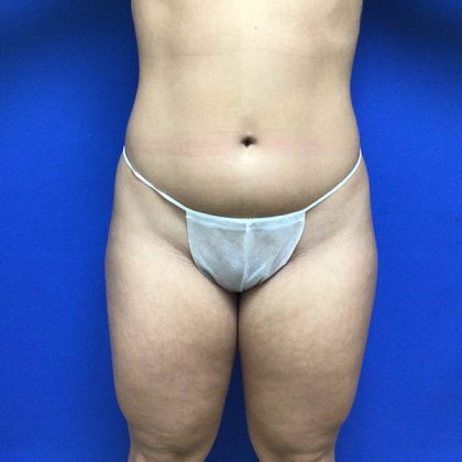 Liposuction Before & After Patient #2201