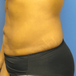 Liposuction Before & After Patient #2206