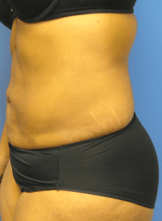 Liposuction Before & After Patient #2206