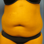 Liposuction Before & After Patient #2206