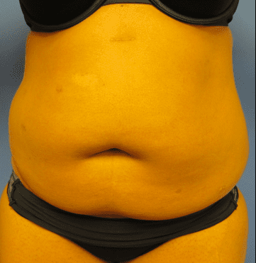 Liposuction Before & After Patient #2206