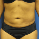 Liposuction Before & After Patient #2206