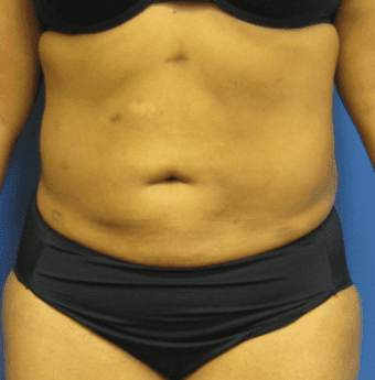 Liposuction Before & After Patient #2206