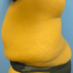 Liposuction Before & After Patient #2206