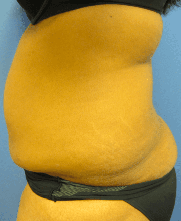 Liposuction Before & After Patient #2206