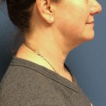 Liposuction Before & After Patient #2216