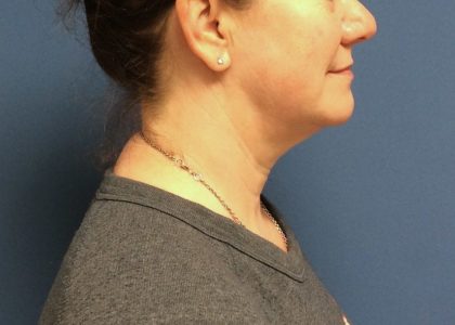 Liposuction Before & After Patient #2216