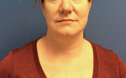 Liposuction Before & After Patient #2216