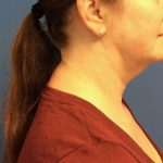 Liposuction Before & After Patient #2216