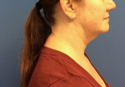 Liposuction Before & After Patient #2216