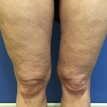Liposuction Before & After Patient #2221