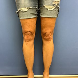 Liposuction Before & After Patient #2221
