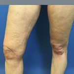 Liposuction Before & After Patient #2221