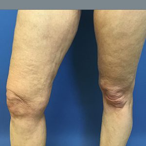 Liposuction Before & After Patient #2221