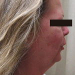 Liposuction Before & After Patient #2226