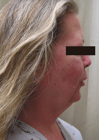 Liposuction Before & After Patient #2226