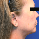 Liposuction Before & After Patient #2226