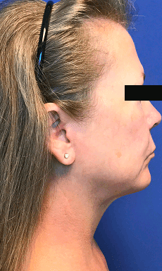 Liposuction Before & After Patient #2226