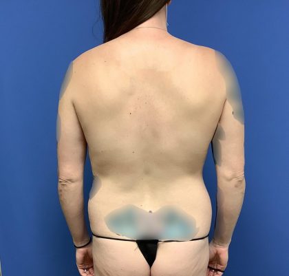 Liposuction Before & After Patient #2229