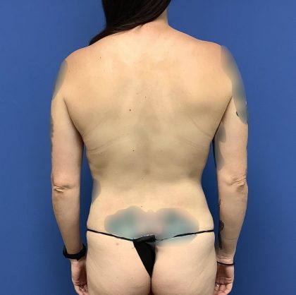 Liposuction Before & After Patient #2229