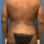 Liposuction Before & After Patient #2232