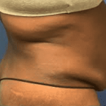 Liposuction Before & After Patient #2232