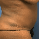 Liposuction Before & After Patient #2232