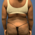 Liposuction Before & After Patient #2232