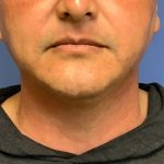 Liposuction Before & After Patient #2237