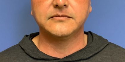 Liposuction Before & After Patient #2237