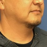 Liposuction Before & After Patient #2237