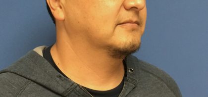 Liposuction Before & After Patient #2237