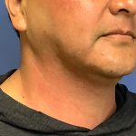 Liposuction Before & After Patient #2237