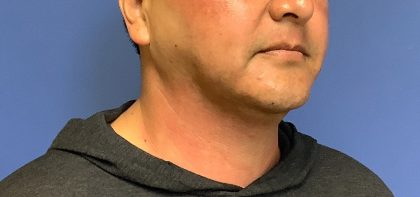 Liposuction Before & After Patient #2237