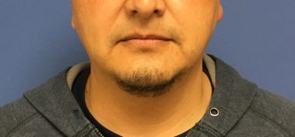 Liposuction Before & After Patient #2237