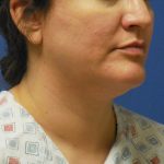 Liposuction Before & After Patient #2242