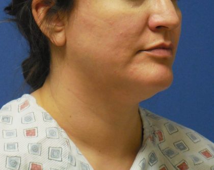 Liposuction Before & After Patient #2242