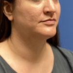 Liposuction Before & After Patient #2242