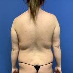 Liposuction Before & After Patient #2245