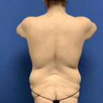 Liposuction Before & After Patient #2248
