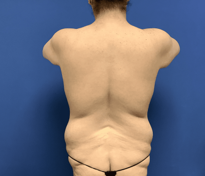 Liposuction Before & After Patient #2248