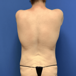 Liposuction Before & After Patient #2248