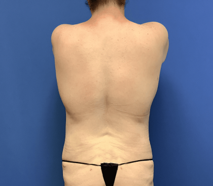 Liposuction Before & After Patient #2248